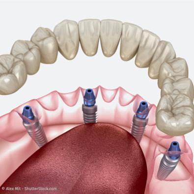 All-On-4 Zahnimplantate