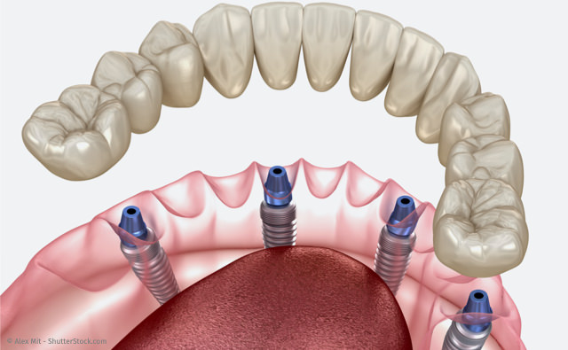 All-On-4: Nur vier Implantate pro Kiefer für feste Zähne